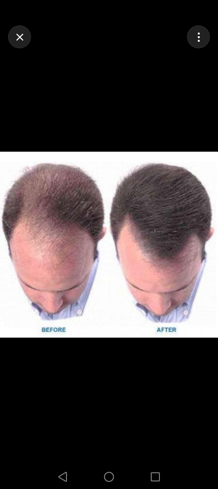 Kirkland Minoxidil 5% Topical Solution (6-in-1 Box) + Free Derma Roller
