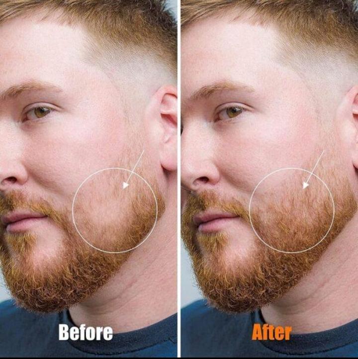 Kirkland Minoxidil 5% Topical Solution (6-in-1 Box) + Free Derma Roller